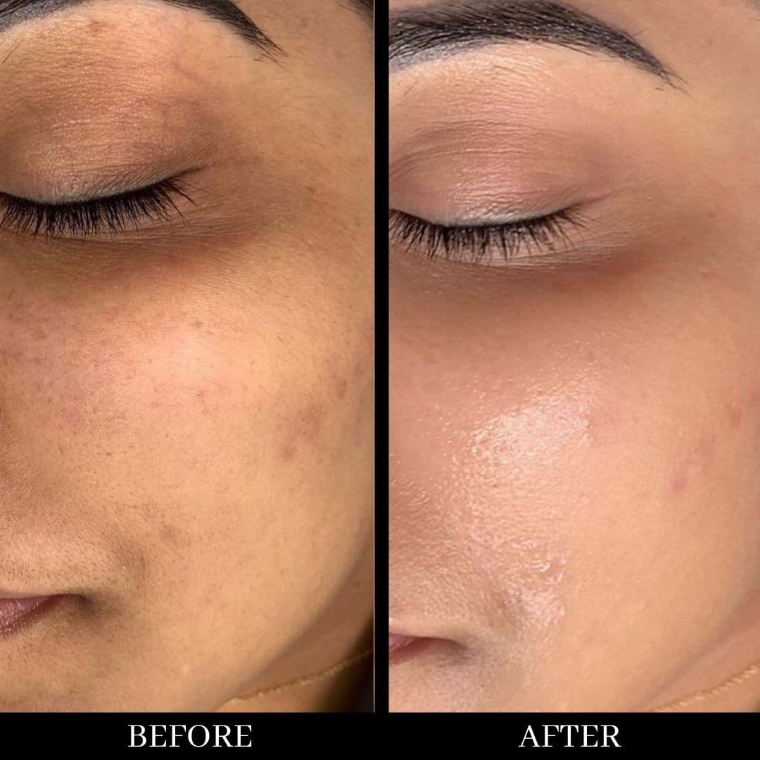 Before and after facial treatment showing skin improvement